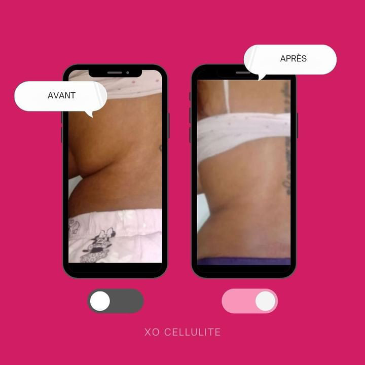 Xô Cellulites – Gel